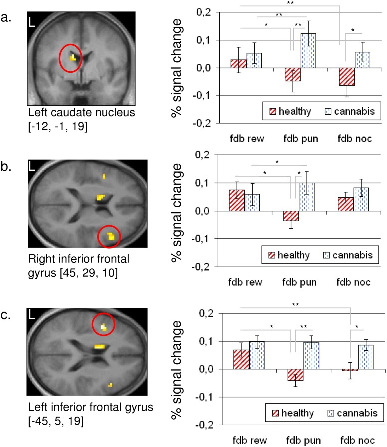 fMRI data regarding the feedback period.Statistical parametric maps representing the interaction contrast between ‘group’ (healthy, cannabis users) and ‘task feedback’ (fdb rew, fdb pun, fdb noc). Percent signal change derived from the (a) left caudate nucleus, (b) right inferior frontal gyrus, and (c) left inferior frontal gyrus. All regions of interest are circled in red. All statistical parametric maps are thresholded at p[uncorr] < 0.001 for k > 10.** p < 0.01;* p < 0.05.Error bar represents SEM.