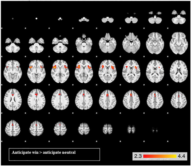Brain activation for the reward anticipation contrast across both drug conditions in the bilateral insula cortex and the paracingulate gyrus. From the top left, slice images progress upward, on a ventral dorsal trajectory. The colours represent z values.