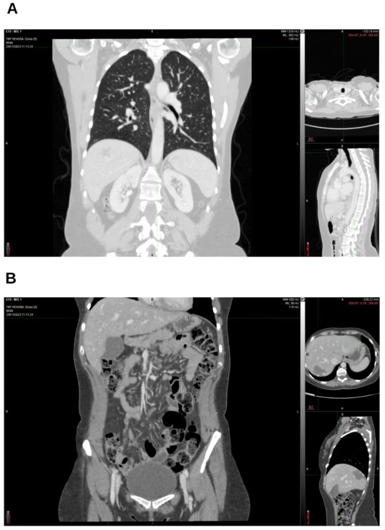 In November 2023, the lung (A), abdomen, and pelvis (B) CT scan was still negative.
