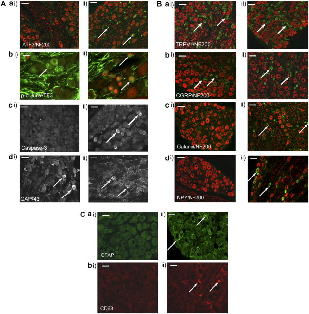 Immunohistochemical characterisation of the L5 DRG 14 days following perineural HIV-1 gp120. (A) Examples of the neuronal expression of (a) ATF3 (green) co-stained for NF-200 (red); scale bar = 100 μm and (b) p-c-Jun (green) co-stained for ATF3 (red); scale bar = 30 μm (c) caspase-3 and (d) GAP-43 with particular reference to high expressing cells; scale bar = 50 μm. (B) Examples of the neuronal expression of (a) TRPV1 (green), (b) CGRP (green), (c) galanin (green) and (d) NPY (green), all co-stained for NF-200 (red) with co-localisation appearing in yellow; scale bar = 100 μm. (C) Examples of the non-neuronal cell expression of (a) the satellite cell marker GFAP (green) and (b) the macrophage marker CD68 (red); scale bar = 50 μm. Arrows indicate examples of cells immunoreactive for the protein of interest. All images are from the L4/L5 dorsal root ganglia of animals exposed to (i) perineural RSA at day 14 versus (ii) perineural HIV-1 gp120. There was a statistically significant increase in the number of cells expressing ATF3, caspase-3, galanin, NPY, GFAP and CD68 in the DRG ipsilateral to perineural HIV-1 gp120 (n = 4–6) as compared to DRG ipsilateral to perineural RSA (n = 4–6). No change was observed in p-c-Jun, GAP-43, TRPV1 or CGRP expression.