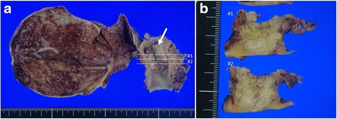 Formalin-fixed surgical specimen. a The surgical specimen showed a tumor measuring 2.4 × 1.9 cm located in the mid-CBD (arrow). b The sectioned surface (at #1 and #2 of Fig. 1) of the resected specimen showed tumor invasion beyond the bile duct serosa