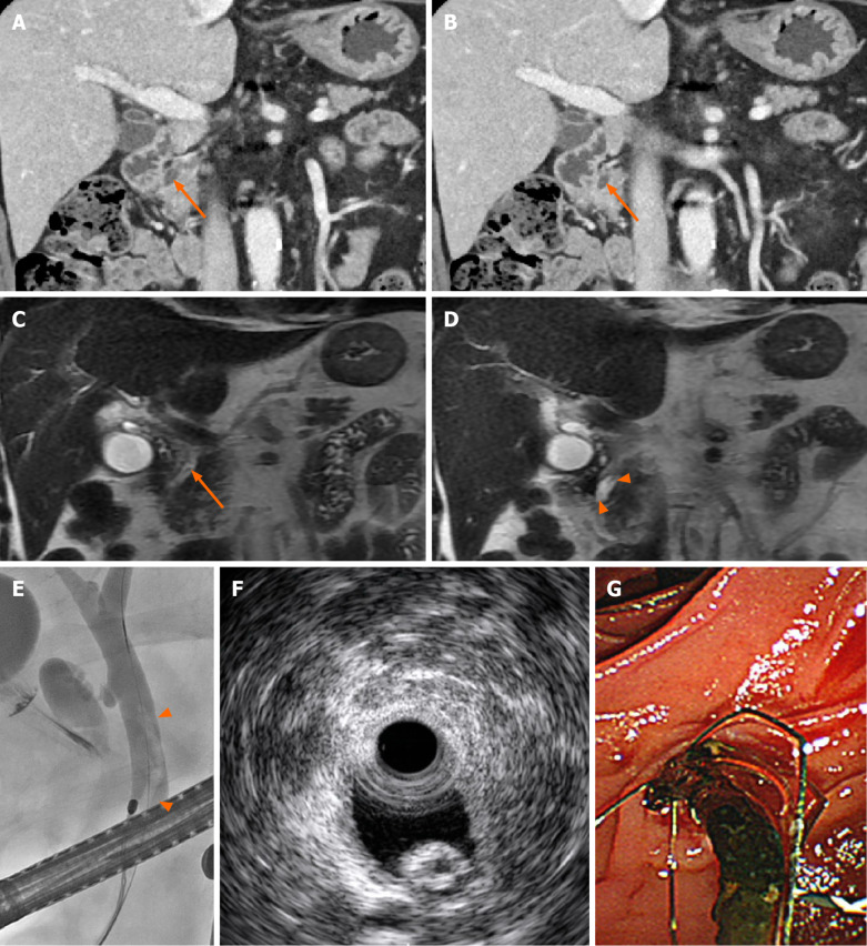 A 72-year-old male with a distal common bile duct stone mimicking Ascaris. A and B: Coronal reformatted images of contrast-enhanced computed tomography showed a hyperattenuated, elongated lesion inside the distal common bile duct (CBD) lumen (arrows); C and D: A T2-weighted coronal image revealed a linear filling defect in the distal CBD lumen with mild ductal dilatation, findings that mimic an Ascaris worm; E and F: An elongated tubular filling defect was seen on endoscopic retrograde cholangiopancreatography, and a hyperechoic lesion with a central hypoechoic area was seen on endoscopic ultrasound; G: A dark-brown-colored CBD stone was discovered through endoscopic removal.