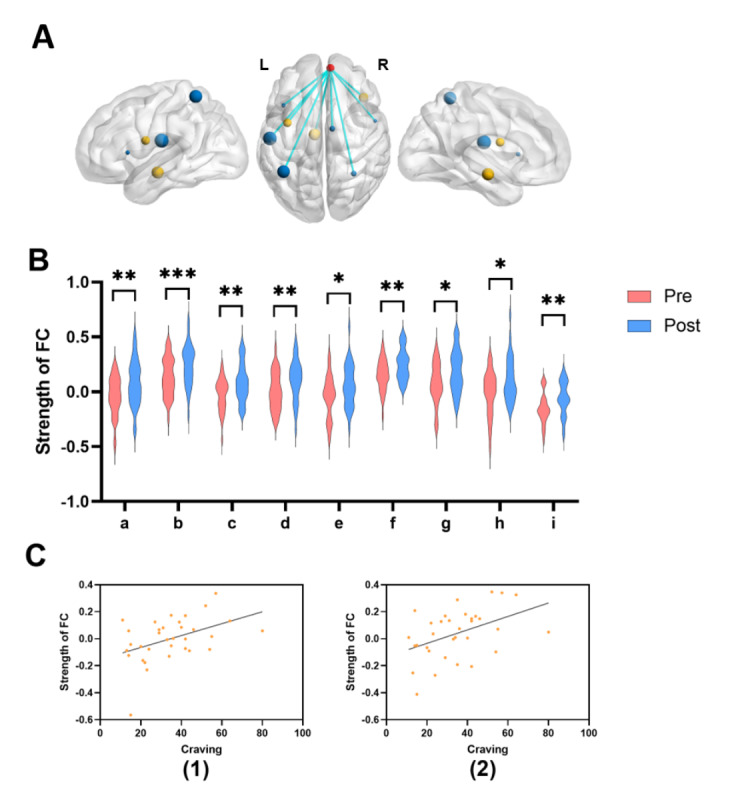Functional connectivity (FC) alterations and their association with game craving following progressive aerobic training. (A) Visualization of the region of interest and functional connectivity. The size of the ball corresponds to the t value obtained from the simple effect. The red ball indicates the right medial superior frontal gyrus (R-mSFG); the blue ball indicates the executive control network including the left postcentral, bilateral superior frontal gyrus (SFG), left inferior frontal gyrus (IFG), right precentral gyrus, and right middle cingulate gyrus (MCG); and the yellow ball indicates the reward network including the bilateral insula and left substantia nigra. (B) Whole brain–based functional connectivity (FC) results. The x-axis shows the different functional connections: a, the R-mSFG to the left postcentral gyrus; b, the R-mSFG to the right insula; c, the R-mSFG to the left superior parietal gyrus (SPG); d, the R-mSFG to the left IFG; e, the R-mSFG to the right precentral gyrus; f, the R-mSFG to the left substantia nigra; g, the R-mSFG to the right MCG; h, the R-mSFG to the right SPG; i, the R-mSFG to the left insula. Pre, pretest before the training; Post, posttest after the training. * P<.05, ** P<.01, *** P<.001. (C) Correlation analysis between FC results and levels of game craving. (1) Correlation results between game craving and FC strength between the R-mSFG and left postcentral gyrus in the progressive aerobic training group. (2) Correlation results between game craving and FC strength between the R-mSFG and the right precentral gyrus.