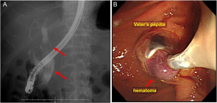 ERCP and the image of Vater’s papilla. ERCP showing a filling defect (arrows) in the CBD and a dilated CBD (a). EST revealed the defect was not choledocholithiasis but a hematoma in the CBD, and the hematoma was drained through the incised Vater’s papilla (b)