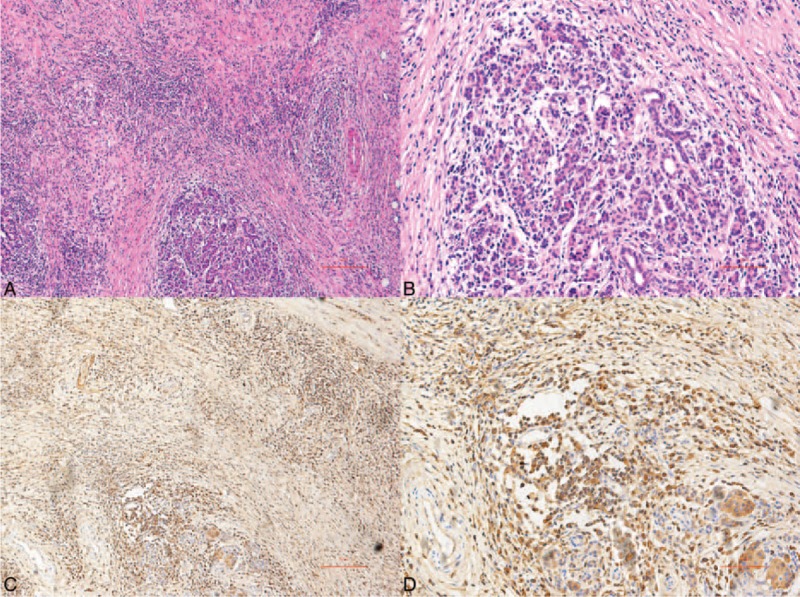 Histopathologically, this case was characterized as IgG4-related sclerosing chronic pancreatitis. (A) Hematoxylin and eosin staining (40×), (B) hematoxylin and eosin staining (100×), (C) significant infiltration of IgG4-positive cells (40×), (D) significant infiltration of IgG4-positive cells (100×).