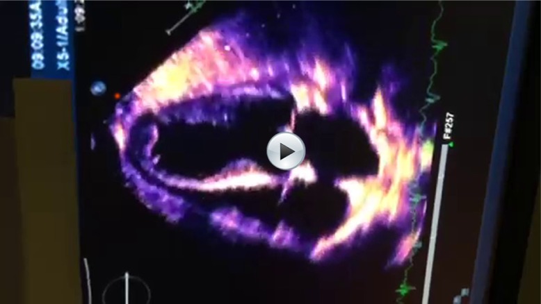 Transthoracic echocardiogram showing a calcified apical thrombus and global hypokinesis.