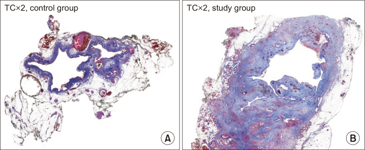 Masson’s trichrome (TC) staining (original magnification, ×2) comparing pericholedochal fibrosis between control (non-drained) and study (preoperatively drained) groups. The control group (left) shows thin pericholedochal collagen (blue staining) with minimal fibrosis. In contrast, the study group (right) exhibits dense, thick pericholedochal collagen deposition surrounding the common bile duct, highlighting the significant difference in fibrotic burden induced by preoperative biliary drainage with plastic stents.