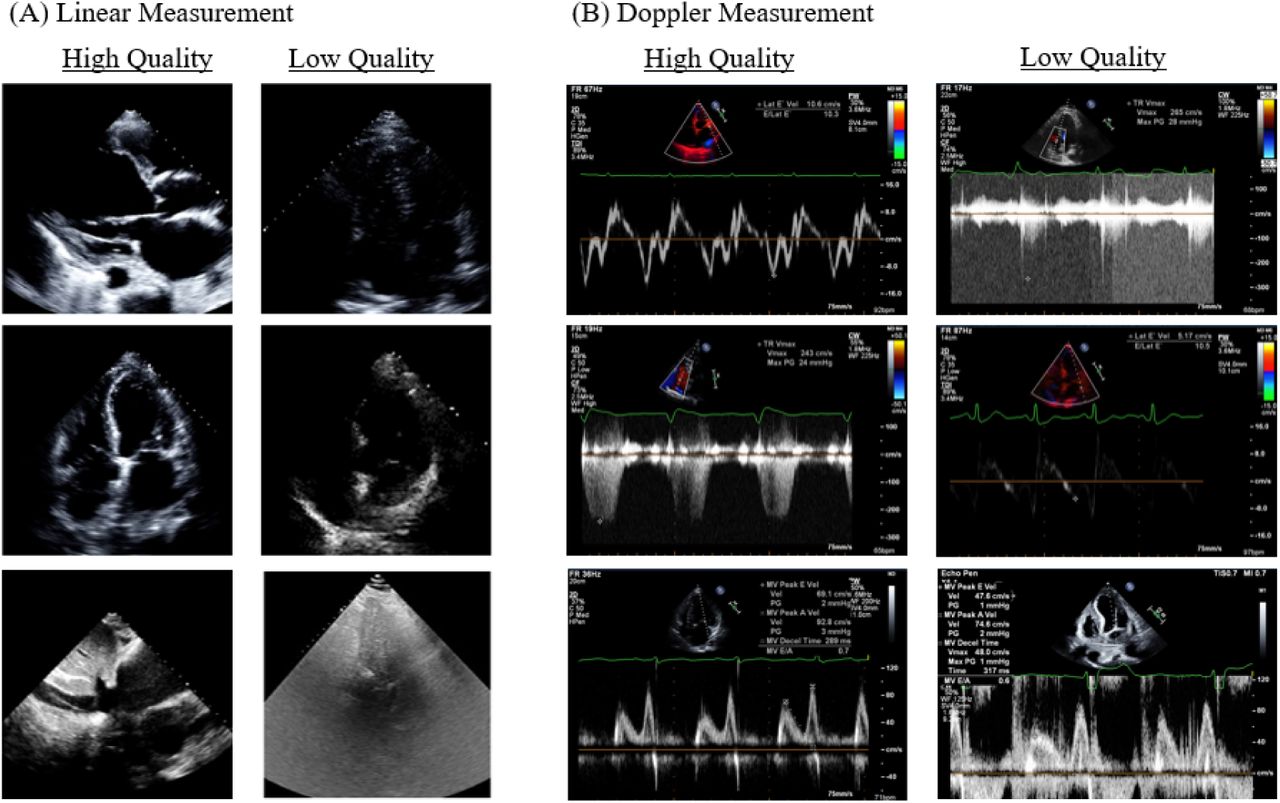 Representative images of quality control model datasetRepresentative images demonstrating variations in image quality within the quality control model dataset. High-quality images (left) and low-quality images (right) with blur or noise in the linear measurement model (A) and Doppler imaging models (B).
