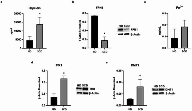 Iron metabolism in macrophages obtained from SCD pediatric/young patients. Evaluation of hepcidin (a) release from sickle cell disease (SCD) macrophages compared to healthy donors’ (HD) macrophages, revealed through an enzyme-linked immunosorbent assay (ELISA). The graphs show hepcidin levels (pg/mL) as the mean ± standard deviation (SD). An unpaired t-test was performed for statistical analysis. FPN1 (b), TfR1 (d), and DMT1 (e) protein expression levels in SCD macrophages of pediatric/young patients’ compared to HD, evaluated by Western blotting, starting from 15 µg of total lysates. The most representative images are displayed. The protein bands were detected through Image Lab Ink 6.1 software “BIORAD”, the intensity ratios of immunoblots compared to CTR, taken as 1, were quantified after normalizing with the respective controls. The relative quantification for these proteins, normalized for the housekeeping protein β-Actin, is represented in the histograms as the mean ± SD. An unpaired t-test was performed for statistical analysis. Original blots/gels are presented in Supplementary Uncropped WB Figures. Fe3+ (c) intracellular concentrations (nmol/µL) in HD and SCD macrophages of pediatric/young patients’, determined by iron assay. Histogram shows Fe3 + concentration as the mean ± SD. An unpaired t-test was performed for statistical analysis. * p ≤ 0.05 compared to HD.