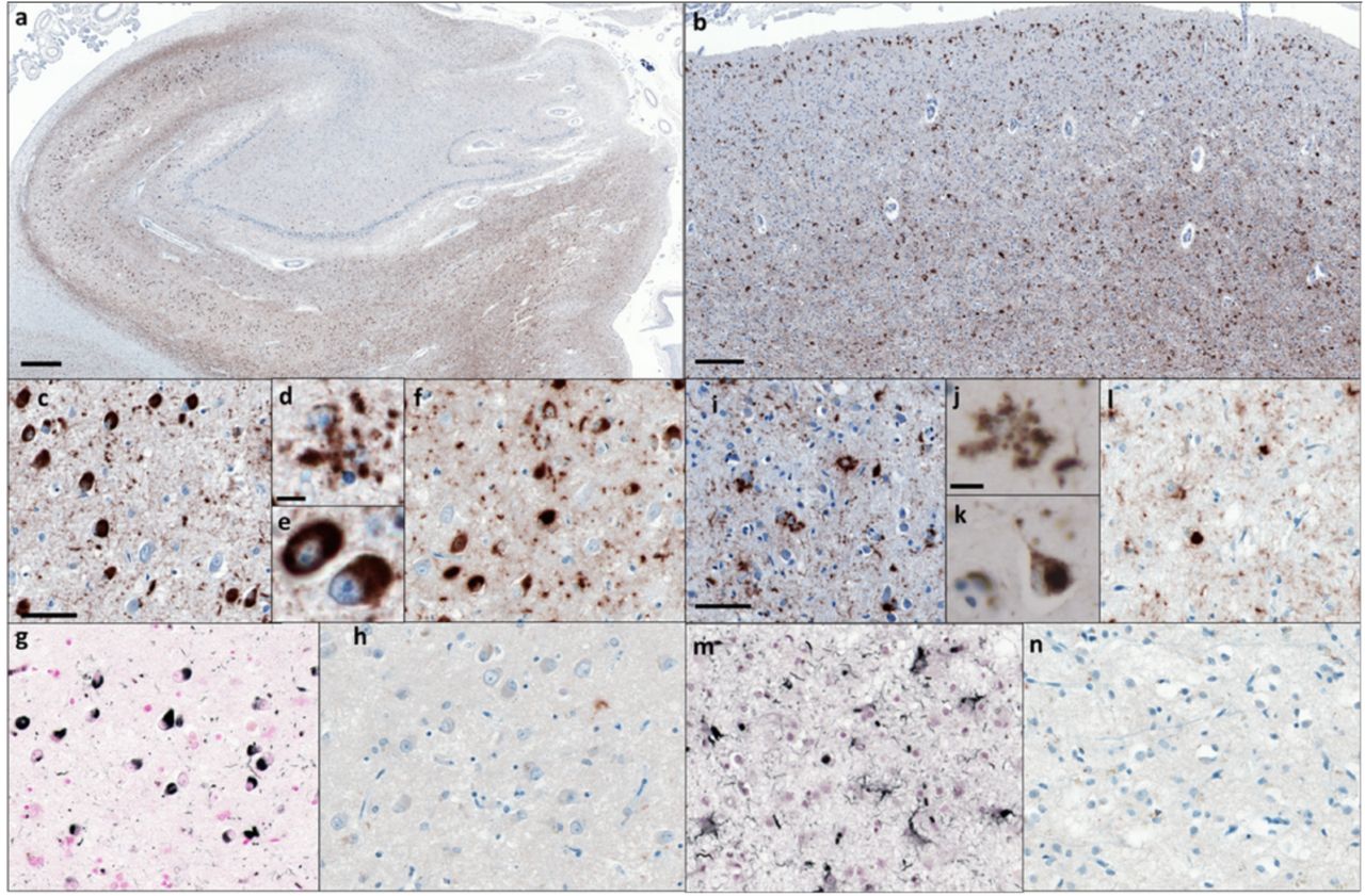 Tau pathology in Limbic-predominant Neuronal inclusion body 4R Tauopathy (LNT, PSP-F case 2)a) Low power view of hippocampus stained with antibody AT8 (pS202/pT205 tau). b) Low power view of frontal cortex stained with AT8. c) Higher power view of hippocampus stained with AT8. d) AT8-positive globular astrocyte in hippocampus. e) AT8-positive neurons in hippocampus. f) Hippocampus stained with antibody RD4 (specific for 4R tau). g) Gallyas-Braak silver-positive neurons and glial cells in hippocampus. h) Hippocampus stained with antibody RD3 (specific for 3R tau). i) Higher power view of frontal cortex stained with AT8. j) AT8-positive globular astrocyte in frontal cortex. k) AT8-positive neruron in frontal cortex. l) Frontal cortex stained with RD4. m) Gallyas-Braak silver-positive neurons and glial cells in frontal cortex. n) Frontal cortex stained with RD3. Scale bars: 400 μm (in a); 200 μm (in b), 50 μm (in c, f, g, h, i, l, m, n); 10 μm (in d, e, j, k).