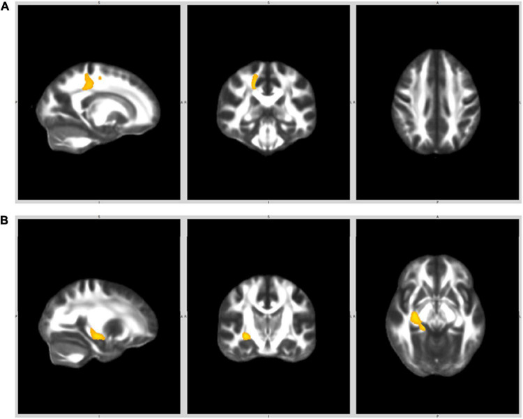 White matter clusters where FA was significantly lower in FEP compared to HC. (A) Right posterior cingulate gyrus (right superior and posterior corona radiata). (B) Right parahippocampal gyrus (cingulam, fornix).