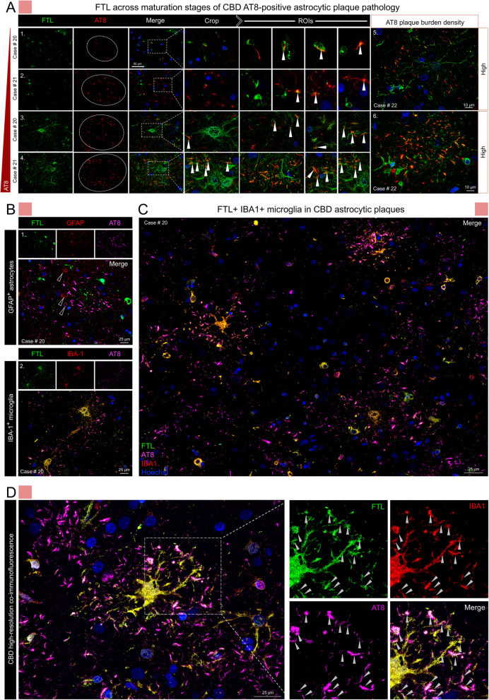 Astrocytic plaques in CBD frontal cortex associate with FTL laden microglia. A FTL-positive cellular structures are associated with AT8 phospho-tau in small (series 1–2, 5) and large (series 3–4, 6) APs. In larger and more mature APs FTL-positive cells are increased in size and become localized in proximity to a center of APs (series 3–4). B Triple labelling of FTL (green), AT8 (magenta), and GFAP (red, series 1) or IBA1 (red, series 2) show that large FTL-positive cells located in the centers of mature APs have microglial, but not astrocytic identity. C Tile image of triple FTL/AT8/IBA1 labeling across CBD cortical tissue showing the frequency and extent of co-localization between FTL laden microglia and phospho-tau APs. D High magnification image of an FTL + microglia cell infiltrating an astrocytic plaque. Grey filled arrowheads denote processes with FTL/AT8/IBA1 triple co-localization. Abbreviations: CBD, corticobasal degeneration; FTL, ferritin light chain; IBA1, microglial marker ionized calcium-binding adapter molecule 1; GFAP, glial fibrillary acidic protein; APs, astrocytic plaques