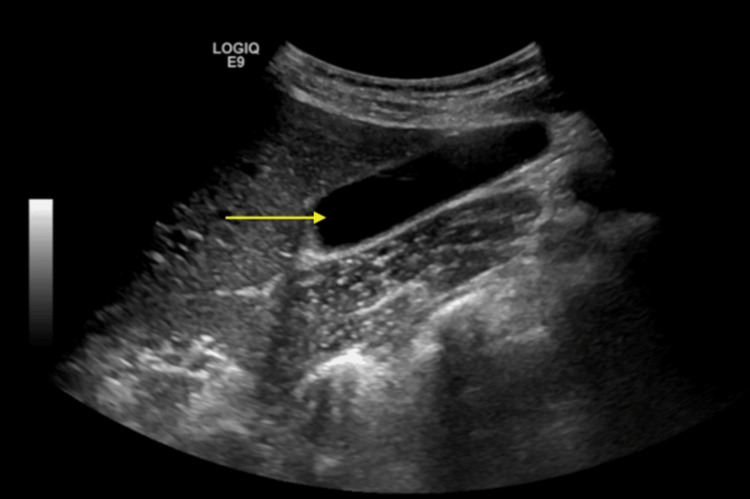 Ultrasound of the right upper quadrant (RUQ) shows a normal-appearing gallbladder without gallstones.