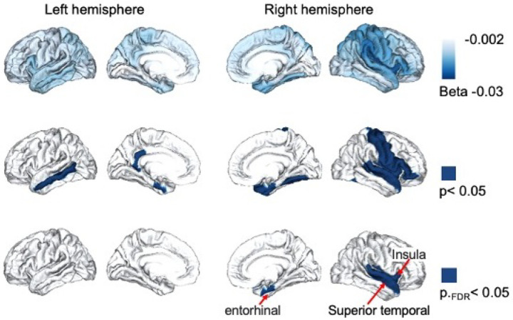 PGS_CRP is associated with variations in age-related cortical thinning in Adolescence, with strongest acceleration effect in the medial temporal lobe. Cortical thickness naturally decreases with maturation. This figure illustrates the interaction between polygenic scores for C-reactive protein (PGS_CRP) and age, showing how genetic predisposition to inflammation influences the trajectory of cortical thinning during adolescence. The top row shows the effect sizes (β3) for the interaction term (Age × PGS_CRP), with darker blue indicating stronger associations with accelerated cortical thinning throughout the brain. The middle row highlights regions where the interaction term was significant at meta-analysis p<0.05), and the bottom row identifies regions that meta-analysis results passed the false discovery rate (FDR) threshold (pFDR<0.05).