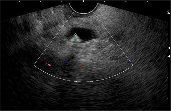 An endoscopic ultrasound (EUS) image revealing a single stone in a dilated common bile duct.
