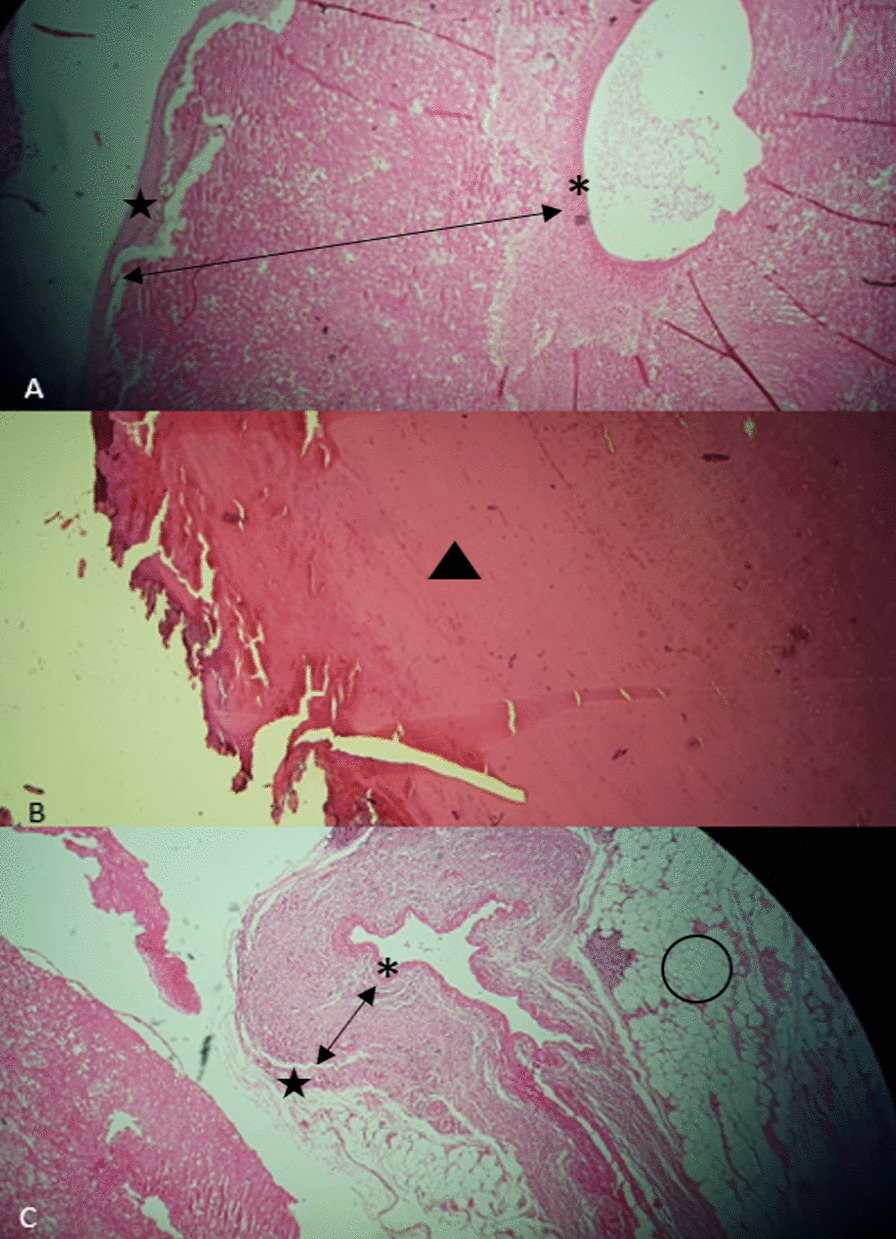 Some sections of the resected aneurysms are shown by H&E staining under the microscope. A, C The small star indicates the intima and the double-ended arrow indicates the media, which consists in part of hypertrophic smooth muscle and hyalinized necrosis. Large stars indicate an adventitial layer. The circle indicates adipose tissue. Fibrinoid necrosis and inflammatory cells were not seen in the resected aneurysms’ walls. B Black arrowhead indicates thrombus