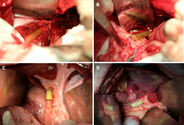 Surgical procedures of extrahepatic common bile duct reconstruction. A: End-to-end anastomosis was carried out between the proximal stump of the common bile duct (CBD) and the animal-derived artificial bile duct (2 cm in length) after resection of a 2 cm distal CBD segment (group A); B: End-to-side anastomosis was performed between the distal stump of the animal-derived artificial bile duct and the duodenum to complete the repairment of the distal CBD defect (group A); C and D: End-to-end anastomoses were conducted between the stumps of CBD and the animal-derived artificial bile duct (2 cm in length) to repair the 2 cm intermedial CBD defect (group B).