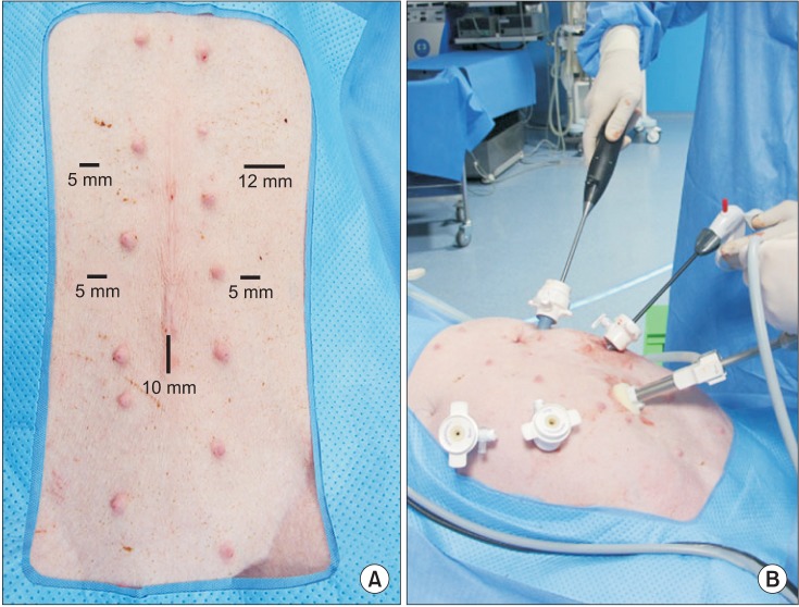 Trocar placement and surgeon position during laparoscopic choledochojejunostomy (CJ). (A) Trocar placement. (B) Position of the surgeon during laparoscopic CJ.