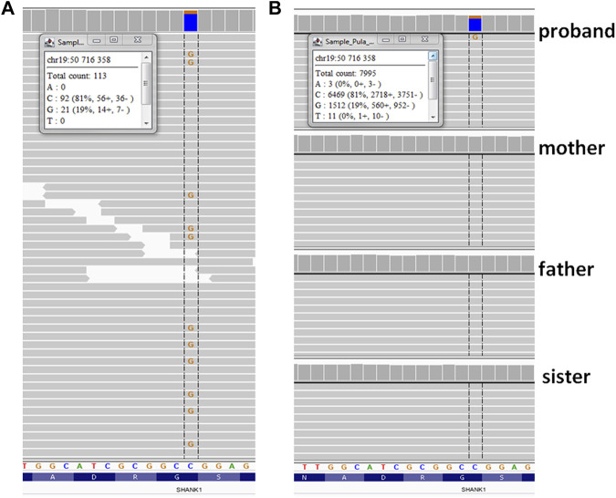 Results of sequencing variant identified in SHANK1gene—Integrative Genomic Viewer (IGV) screen shot. (A) whole-exome sequencing; (B) ADS (amplicon deep sequencing). Insets show the numbers and percentages of variant NGS reads.