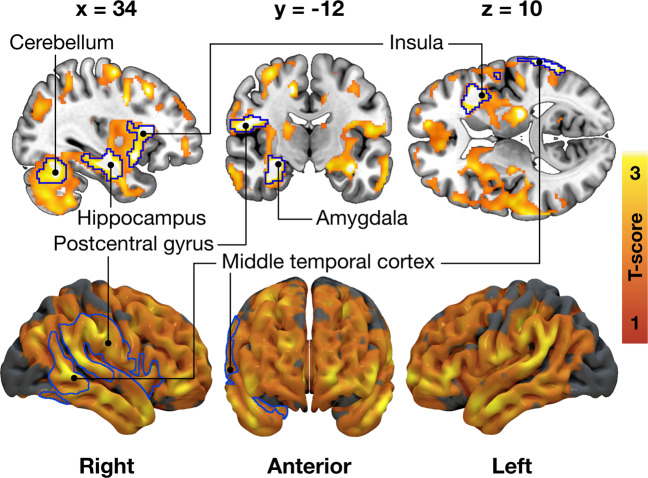 Association between External eating and decreased μ-opioid receptor availability in the 92 subjects (70 males and 22 females) scanned with [11C]carfentanil.The blue outline marks brain regions where lower [11C]carfentanil binding potential (BPND) associated with higher External eating score, age and PET scanner as nuisance covariates, cluster forming threshold p < 0.01, FWE corrected. In the red–yellow T-score scale shown are also additional bilateral associations significant with more lenient cluster-defining threshold (p < 0.05, FWE corrected) for visualization purposes.