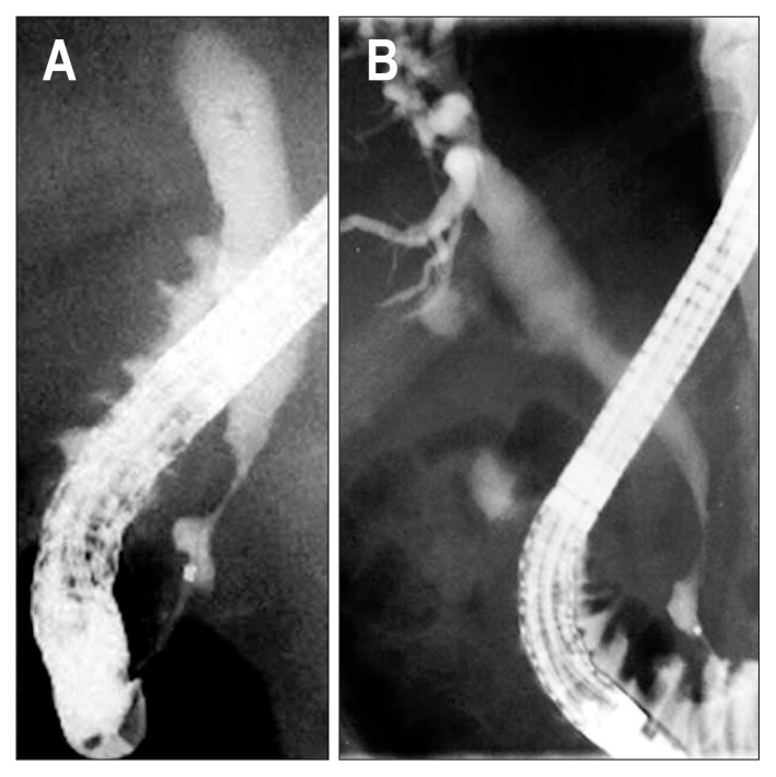 Distal common bile duct (CBD) sign showing that the distal CBD within 1.5 cm from the orifice is maintained without involvement of stenosis (A, B).