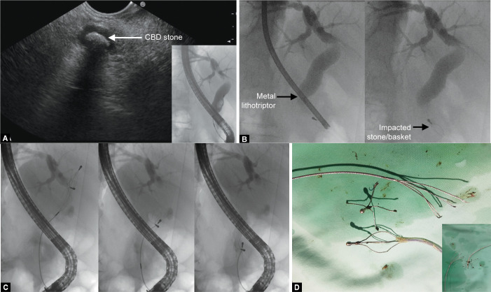 (A) Common bile duct (CBD) stone showed by endoscopic ultrasound and endoscopic ultrasound; (B) Stone/basket complex impacted in the distal CBD; (C) Retrieving the broken basket by a second basket; (D) Broken basket caught by a second basket