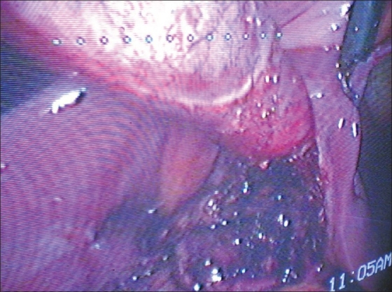 Left sided gall bladder. Retrograde dissection