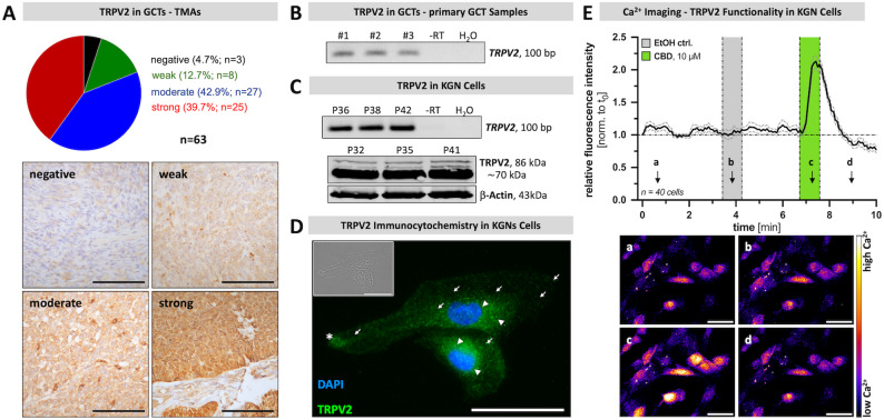 TRPV2 is expressed by GCTs and KGN cells and is functional in KGN cells. A TMA samples of granulosa cell tumors derived from 63 patients were subjected to immunohistochemistry targeting TRPV2 and subdivided into four categories depending on their signal intensity/density (negative (black), weak (green), moderate (blue), strong (red). Representative images of the four categories negative (upper left), weak (upper right), moderate (lower left) and strong (lower right) are shown. Scale bar 50 μm. B Primary GCT cells derived from three individual patients (GCT#1–3) express TRPV2 mRNA, as demonstrated by RT-PCR. PCR amplicon size 100 bp. -RT (no reverse transcription) and H2O (water instead of RNA within the reaction) served as controls. Cropped gel image is shown and original gel images are shown in Supplementary Fig. 8. C KGN cells express TRPV2 both on mRNA (upper panel) and protein level (lower panel). PCR amplicon size 100 bp. Western Blotting revealed several bands sized between 86 kDa and ~ 70 kDa; ß-Actin served as internal loading control, band size 43 kDa. Passages used between 32 and 42 (P32-42). Cropped gel and blot images are shown and original gel images are provided in Supplementary Fig. 9. D Immunocytochemistry showed TRPV2 in KGN cells with fluorescence signals in close proximity to the nucleus (arrow heads), at the periphery (asterisks) or spotted and membrane-bound (arrows). TRPV2 - green; DAPI - blue; insert with phase contrast image. Scale bar 25 µM. E Application of cannabidiol (CBD, 10 µM; green), but not the solvent control ethanol (EtOH ctrl.; gray), elicited transient calcium (Ca2+) fluxes in KGN cells, as reflected by increased fluorescence intensity measured during Ca2+ imaging. Relative fluorescence intensity over time (normalized to starting point t0) of 40 examined KGN cells (mean ± SEM; mean - black line, SEM - gray dotted line), with representative live cell images displayed as pseudo-color images (black-purple - low Ca2+ levels; yellow-white - high Ca2+ levels) at the indicated time points (a-d). Scale bar 50 μm