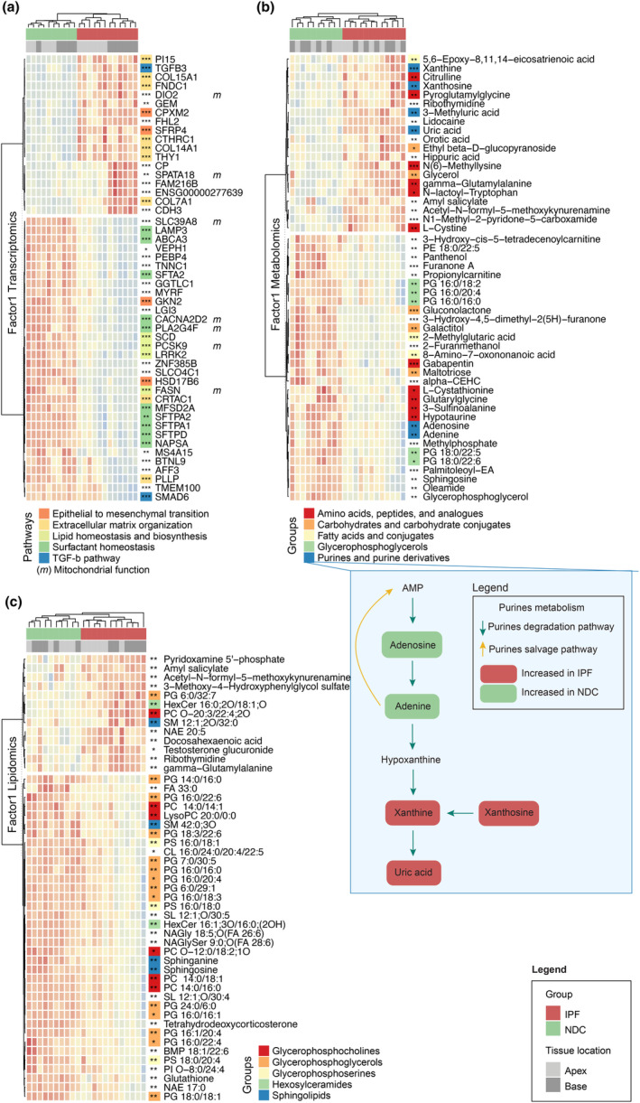 In‐depth characterisation of Factor1. (a) Heatmap representing the top 50 genes with the highest loading values for Factor1, associated with disease and age. Each row represents a gene (z‐score of normalised gene expression) and each column a sample. (b) Corresponding heatmap for metabolites. Each row represents a metabolite (z‐score of normalised metabolites intensities). Purines metabolism pathway (degradation and salvage) with metabolites increased in non‐diseased controls (NDC) (green) or idiopathic pulmonary fibrosis (IPF) (red) samples is highlighted in the orange box. (c) Corresponding heatmap for lipids. Each row represents a lipid (z‐score of normalised lipids intensities). Column annotations depict disease groups and lung tissue locations. Row annotations refer to literature‐based pathways for transcriptomics and metabolomics, and broad lipid classes for lipidomics. Sample sizes are 6 IPF apex, 6 IPF base, 5 NDC apex and 5 NDC base. Statistics represent the result of FDR‐corrected limma differential gene expression testing for transcriptomics and lm for metabolomics and lipidomics with FDR < 0.05, < 0.01 and < 0.001 represented as *, ** and ***, respectively.