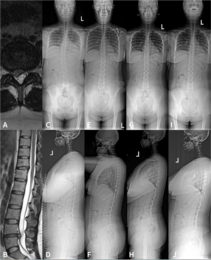 A 36-year-old female was admitted with “recurrent low back pain and right lower limb pain for more than half a year”. She was diagnosed as lumbar disc herniation at L4/5 and was treated with PELD in our hospital. A-D were preoperative lumbar magnetic resonance and anterior and lateral X-ray of the whole spine, Cobb angle: 17.5 °; AVT:22.6 mm, CBD:5.5 mm, SVA:11.4 mm, TK:11.8 °, LL:44.6 °, PI:39.7 °; E-F: postoperative anterior and lateral X-ray of the whole spine, Cobb angle: 5.7 °, AVT:16.7 mm, CBD:5.3 mm, SVA:37.5 mm, TK:13.2 °, LL:48.1 °. G-H were positive and lateral X-ray of the whole spine at 1 month follow-up, Cobb angle was 2.3°, AVT:7.8 mm, CBD:4.9 mm, SVA:35.0 mm, TK:14.1 °, LL:50.7 °, I-J Cobb angle 2.1°, AVT:5.7 mm, CBD:4.1 mm, SVA:29.1 mm, TK:15.9 °, LL:55.2°