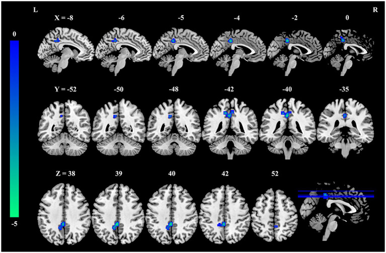MRI brain scans showing different cross-sectional views annotated with blue color highlights. The rows display sagittal, coronal, and axial slices at various coordinates, marked with numbers. A vertical color scale ranging from -5 to 0 uses green to blue shades, positioned on the left.