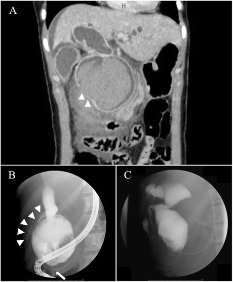 Preoperative imaging findings. a Urgent contrast-enhanced abdominal computed tomography scan, showing a huge cyst with hemorrhaging in the common bile duct (CBD) and a defect of the contrast medium at the right-side wall of the CBD (arrowheads). Fluid collection around the CBD, mainly in the retroperitoneal space, also is observed. b Endoscopic retrograde cholangiopancreatogram, showing leakage of the contrast medium from the right-side wall of the dilated CBD (arrowheads) with anomalous pancreaticobiliary ductal union (arrows). c Cholangiogram taken by the nasal biliary drainage tube, showing dilation of both intra- and extrahepatic bile ducts, indicating a type IVa choledochal cyst according to Todani’s classification