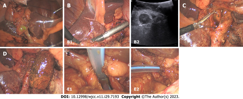 Intraoperative photos. A: Fixation of the gallbladder on the anterior abdominal wall; B: Intraoperative ultrasound; C: Common bile duct stone removal with the Endo BabcockTM; D: Removed common bile duct stone; E: Transductal T-tube insertion and suturing (left: T-tube insertion; right: after suturing).