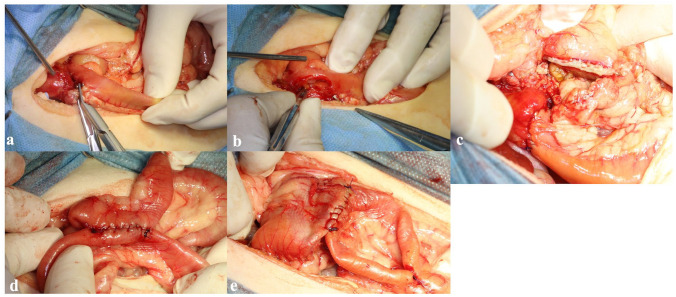 Surgical procedure: (a) ligation of the common bile duct distal to the mass; (b) duodenal perforation; (c) partial gastrectomy and choledochoduodenostomy; (d) Braun anastomosis; and (e) gastrojejunostomy