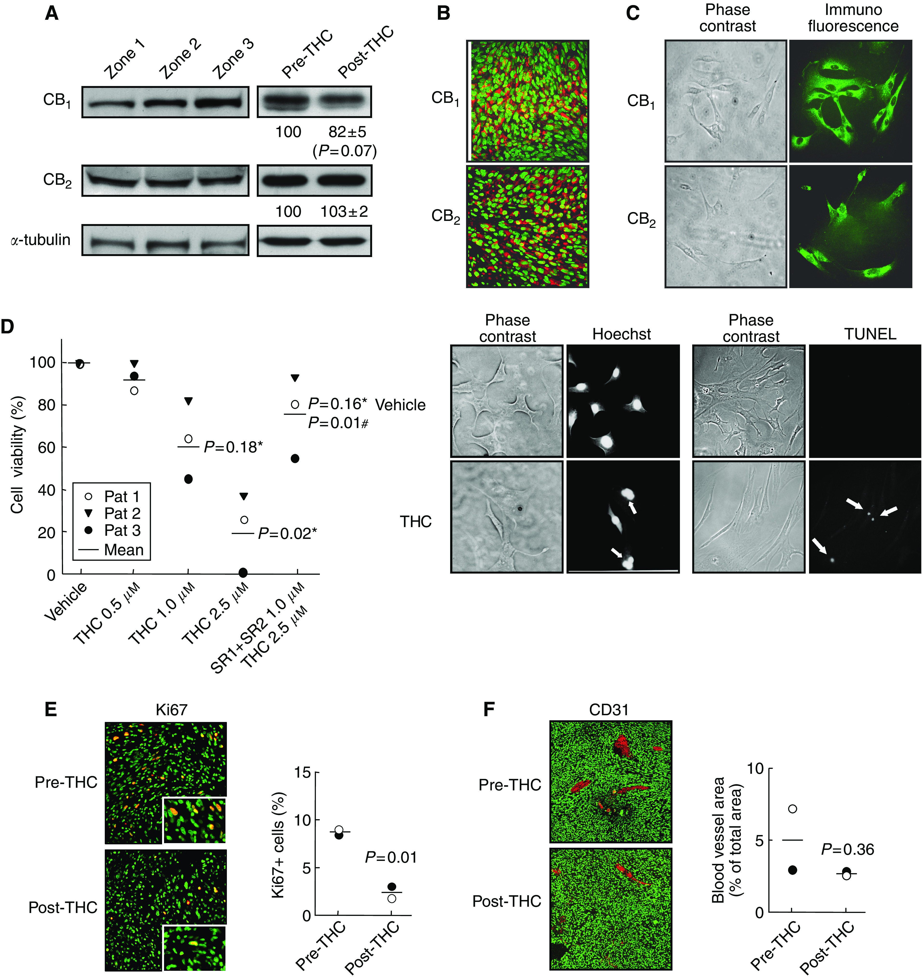 Effect of THC administration on tumour cells. (A) Western blot analysis of CB1 and CB2 receptor expression in three different tumour zones of Patient 1 (left panel) and in tumour biopsies of Patient 1 before and after THC treatment (right panel). Optical density values relative to those of loading controls (α-tubulin) are given for Patients 1 and 2 in arbitrary units. (B) Immunostaining of CB1 and CB2 receptors (red) in a tumour biopsy of Patient 1. Nuclei are stained in green. (C) Immunostaining of CB1 and CB2 receptors (green) in tumour cells obtained from Patient 1. (D) THC-induced apoptotic death of tumour cells obtained from Patients 1–3. Cells were incubated for 48 h with THC and/or 1.0 μM SR141716 (SR1) plus 1.0 μM SR144528 (SR2). Statistical comparison vs vehicle (*) or vs 2.5 μM THC alone (#) is given. Arrows point to Hoechst-stained fragmented nuclei or to TUNEL-positive nuclei in cells from Patient 1 treated with 2.5 μM THC. (E, F) Tumour cell proliferation (Ki67 immunostaining, panel E) and tumour vascularisation (CD31 immunostaining, panel F) as determined by confocal microscopy in Patient 1 (○) and Patient 2 (•) before and after THC treatment. Insets in panel E show higher-magnification micrographs. Cell nuclei are stained in green. Representative micrographs of Patient 1 biopsies are shown.