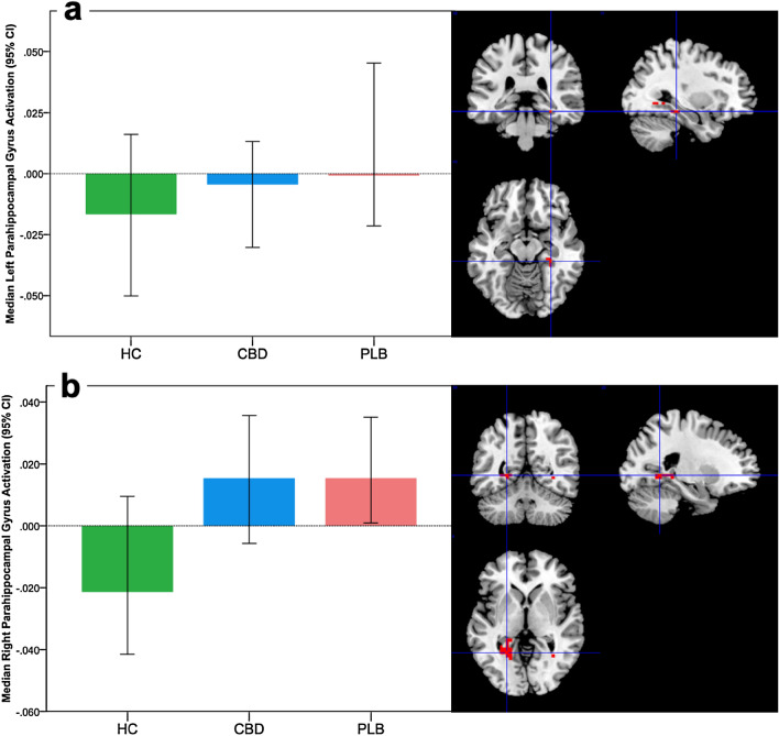 Brain activation during fear processing in CHR participants and healthy controls and the effect of cannabidiol. Clusters where activation differed across the three groups (HC controls, PLB placebo, CBD cannabidiol) in a linear relationship during fear processing. Median activation in each group in a the left parahippocampal gyrus, and b the right parahippocampal gyrus during fear processing, in arbitrary units as indexed using the median sum of squares ratio. The sum of squares ratio statistic refers to the ratio of the sum of squares of deviations from the mean image intensity due to the model (over the whole time series) to the sum of squares of deviations due to the residuals. The right side of the brain is shown on the left of the images