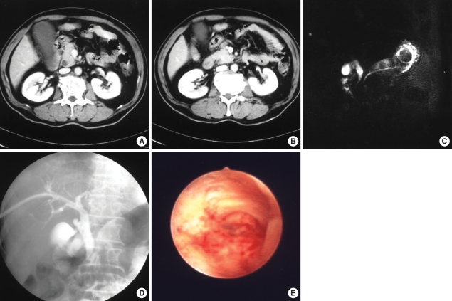 Studies of a 64-yr-old male patient. While radiologic findings suggested a benign stricture, PTCS imaging showed hyperemic mucosa and tumor vessels, and PTCS-guided biopsy data revealed an adenocarcinoma. (A, B) CT image showing no wall thickening or enhancement. (C) MRCP image showing gradual narrowing and symmetric narrowing. (D) Percutaneous transhepatic cholangiogram image showing gradual narrowing and smooth narrowing. (E) PTCS image showing hyperemic mucosa and tumor vessels in the distal common bile duct.