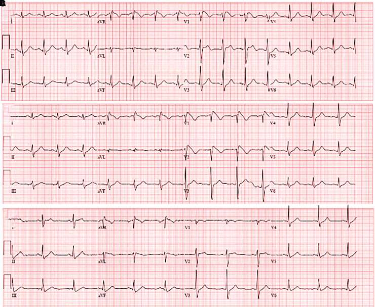 (A) Sinus tachycardia with Type-1 Brugada pattern in right precordial leads, (B) persisted Type-1 Brugada pattern after potassium normalized, and (C) A repeat electrocardiogram at 3 months after abstention of tetrahydrocannabinol showed normal sinus rhythm without Brugada pattern.