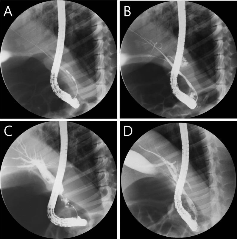 Endoscopic retrograde cholangiogram of miniature pigs. (A) Endobiliary RFA was performed in the distal common bile duct. (B) Immediate post-RFA cholangiogram showed no contrast leakage. (C) Follow-up cholangiogram at four weeks showed adequate post-RFA biliary stricture and definite upstream duct dilation. (D) Another representative follow-up cholangiogram at four weeks showed inadequate post-RFA biliary stricture and mild upstream duct dilation.
