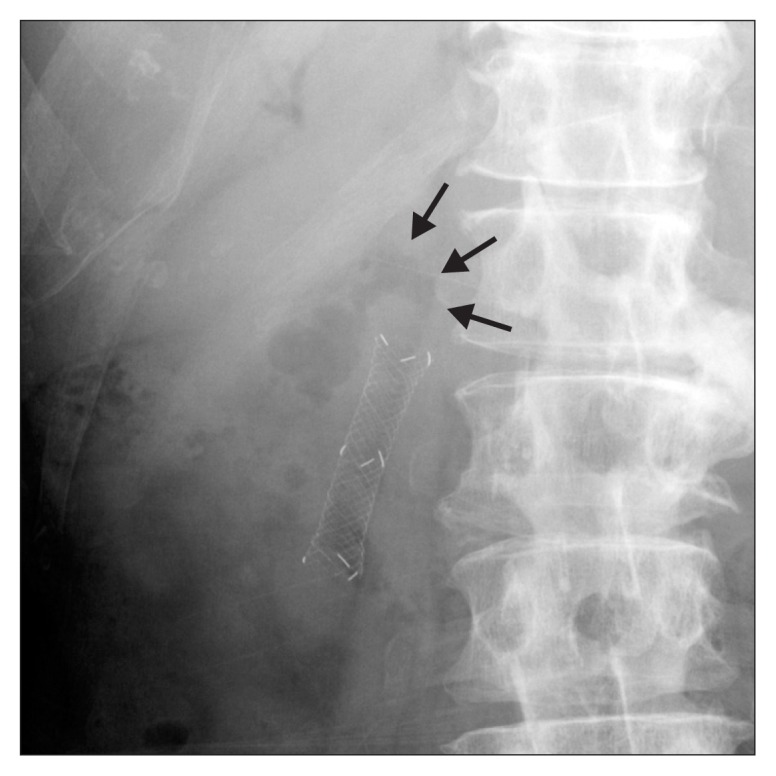 Cholangiographic finding. Endoscopic retrograde cholangiography using carbon dioxide insufflation shows kinking of the common bile duct 1 cm above the proximal end of the metal stent (arrows).