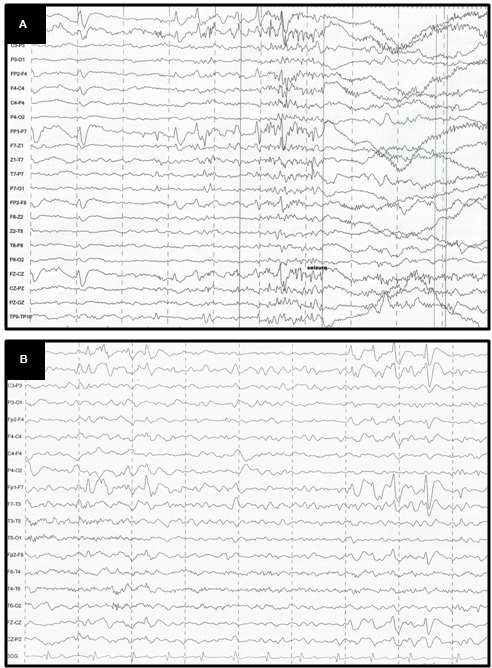 (A) EEG before CBD: generalized, sharp wave, regular, in burst, high voltage in the frontal areas; (B) EEG after CBD: diffuse slowing in the background.