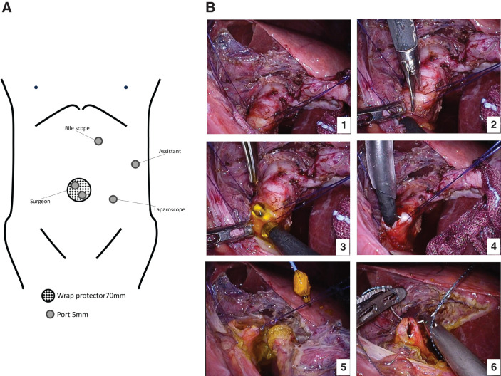 Intraoperative findings. (A) Port placement schema showing the modified arrangement under severe adhesions. A 3-cm mini-laparotomy was created at the umbilicus, through which a Lap Protector was inserted. This incision was also used to insert two 5-mm working ports for the operator’s instruments. A 5-mm camera port was positioned in the left lower abdomen, while a 5-mm assistant port was inserted in the left upper abdomen. An additional 5-mm port was placed just above the planned choledochotomy site for direct choledochoscope access. This arrangement enabled all operative maneuvers to be conducted entirely within the left abdominal cavity. (B) Choledochotomy with traction sutures placed on the common bile duct to facilitate exposure. Impacted stones were fragmented intraductally and extracted using basket forceps. Closure was completed with interrupted sutures at both ends and a continuous running barbed suture in between.