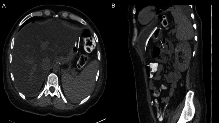(A) Axial and (B) coronal view of the abdomen and pelvis demonstrating successful repair of the gastric leak (white arrows).