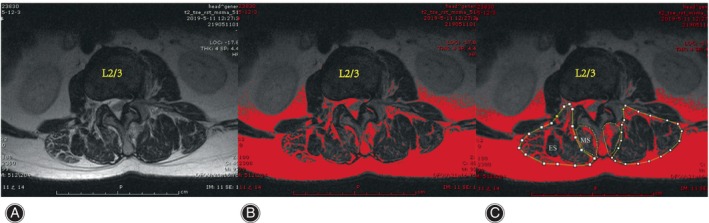 Muscle measurements using ImageJ. MS, multifidus; ES, erector spinae; FIA, fat infiltration area. Choosing the 8‐bit image (A). Using the threshold tool of the program, the red area was measured as FIA (B). The regions of interest were outlined with a graphic cursor (C).