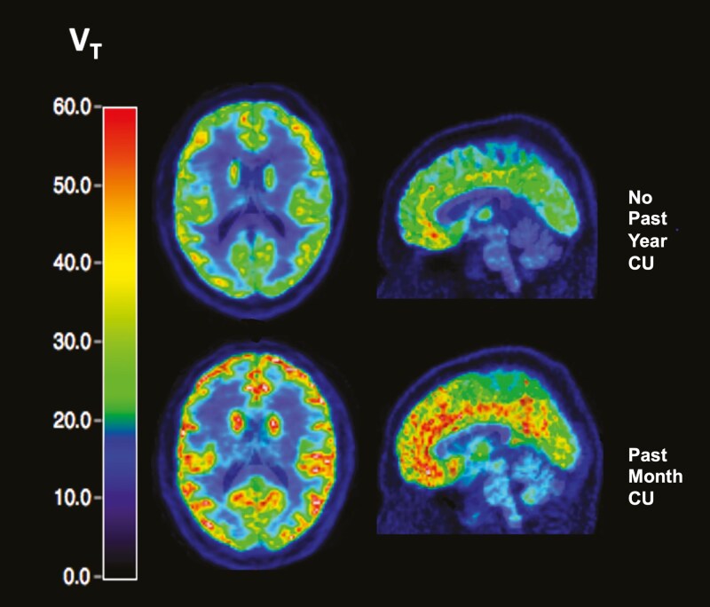 mGlu5 availability (VT) in representative participants with trauma related pathology (both male). Top images depict a participant with no past-year cannabis use (no past-year CU). Bottom images depict participant with past-month or monthly cannabis use (past-month CU). Due to similarities between the past-year CU and past-month CU, a participant was chosen from the past-month CU group because this group also encompassed past-year CU participants.