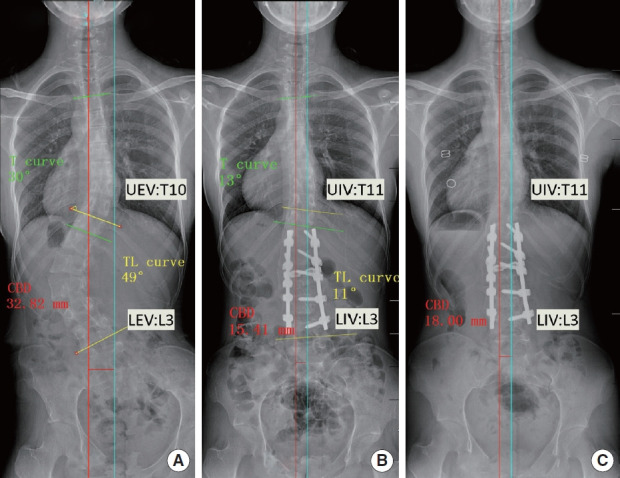 Radiographs of a 16-year-old girl with adolescent idiopathic scoliosis in type C preoperative coronal pattern (A). After selecting the UIV at 1 level caudal to UEV (Cobb-1) and LIV at LEV (B), the coronal balance improved significantly and has been persisting until 2 years after surgery (C). Type C, coronal balance distance (CBD)≥20 mm and coronal C7 plumbline shifts to the convex side of the curve; UIV, upper instrumented vertebra; UEV, upper end vertebra; LIV, lower instrumented vertebra; LEV, lower end vertebra; TL, thoracolumbar.