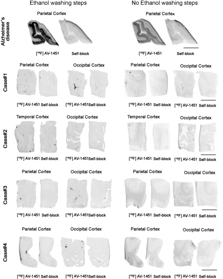 Representative images of phosphor screen autoradiography experiments with and without ethanol washing steps. Identical results were observed in the head to head comparison of both protocols using adjacent brain tissue slices. A strong [18F]-AV-1451 binding signal was observed in cortical regions containing tangles in AD but no [18F]-AV-1451 binding was detected in CTE slices with the exception of the off-target to leptomeningeal melanocytes. Scale bar = 1 cm
