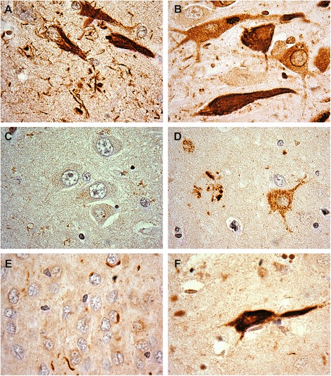 Representative hippocampal tau oligomer (T22) pathology. a AD, b ALSci, c DLBD, d mDLBD (e) FTLD (f) MSA. Counterstained with hematoxylin. Original images taken at 100×