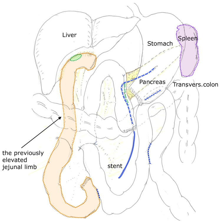 Surgical findings and reconstruction during pancreatic head cancer surgeryIntraoperative findings and schematic illustration of subtotal stomach-preserving pancreaticoduodenectomy (SSPPD). The previously constructed Roux-en-Y limb from prior congenital biliary dilatation surgery was carefully preserved. The original hepaticojejunostomy remained intact and was reused for reconstruction, thereby avoiding additional bowel resection or creation of a new biliary-enteric anastomosis (author’s original illustration).