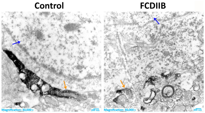 CB1R-immunostained sections of the somata of principal cells in prefrontal cortex of control and FCDIIB subjects in layer III by electron microscopy. The CB1R-immunopositive perisomatic terminals are establishing symmetrical synapses with the principal neurons (orange arrows). Blue arrows show the nuclei of the principal cells. Scale: 200 nm.